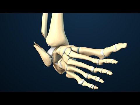 Ankle Fracture Surgery