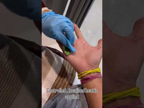 Thumbnail for video: Agni Karma Therapy at Our Mohali Clinic