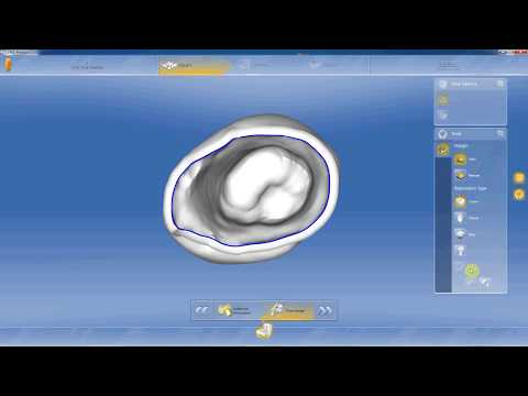 Milling a crown from STL file on Cerec MCXL