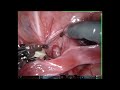 robotic ureteral reimplantation after vantris obstruction for VUR