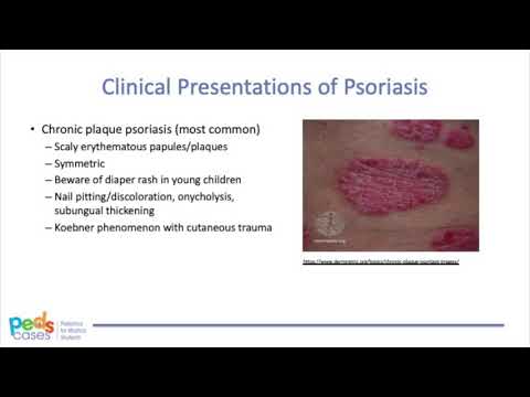Approach to Pediatric Psoriasis