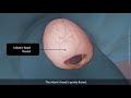 Primary Vertex Caesarean Section C Section TVASurg