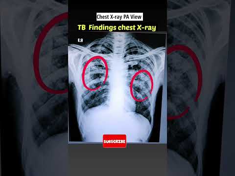 TB hone par Chest x-ray  kaisa dikhta hai ? #xray #shorts