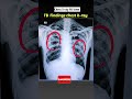 TB Hone Par Chest X Ray Kaisa Dikhta Hai Xray Shorts