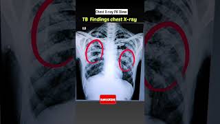 Download lagu TB hone par Chest x-ray  kaisa dikhta hai ? #xray #shorts mp3 Download lagu TB hone par Chest x-ray  kaisa dikhta hai ? #xray #shorts mp3