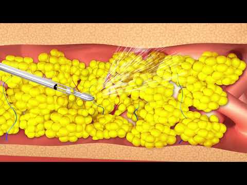 SEE HOW IT WORKS, Water Assisted Liposuction with body jet