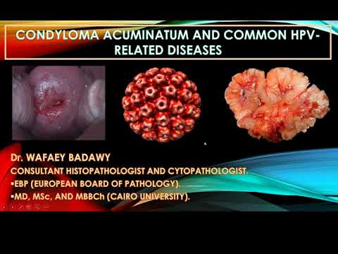 a condyloma kialakulása