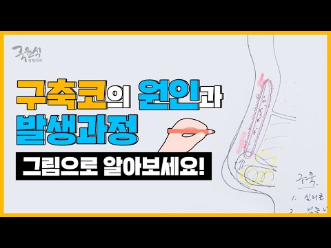 구축코의 원인과 발생과정. (Causes and Developing process of Contracted Nose)