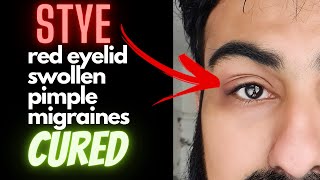 How To Get Rid of A Stye | Swollen Red Eyelids BEST CURE | Doctor