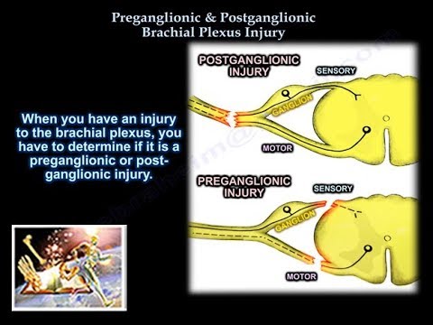 Preganglionic and  Postganglionic  Injuries - Everything You Need To Know - Dr. Nabil Ebraheim