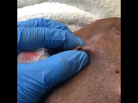 Best Pimple Removal