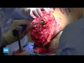 Osseointegration of the Tibia After Primary Amputation - Live Surgery