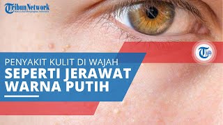 Milia, Penyakit Kulit pada Area Kulit Wajah, Berbintik Kecil seperti Jerawat Berwarna Putih