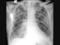 Chest x-ray interpretation, pulmonary edema, heart ...