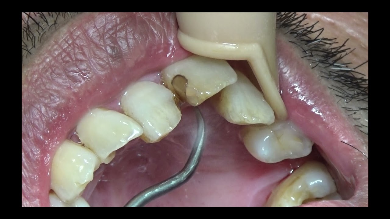 上尾の歯医者の歯周病・口臭予防の歯石取り動画 R5年10月6日 |  健康・口腔ケア