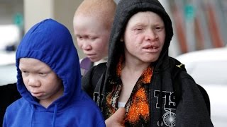 Tanzanian Albino Children Attacked For Body Parts Used In Witchcraft Seek Care In US