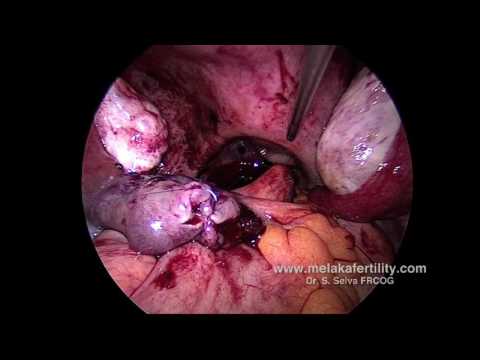 Operative Laparoskopie bei Extrauteringravidität
