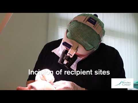 download lagu mp3 mp4 Heitmann Haartransplantation, download lagu Heitmann Haartransplantation gratis, unduh video klip Heitmann Haartransplantation