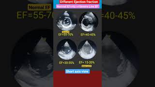 Normal to severe Low Ejection fraction Echo l EF 15-20% #echo #heartattack #shorts