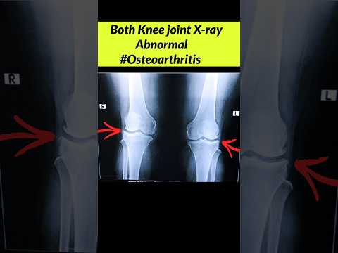 Normal Vs Abnormal Knee joint Digital X-ray #osteoarthritis #xray #radiographerusn