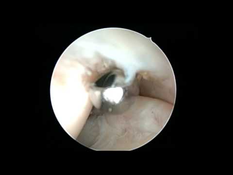 Artroza procedurii articulației genunchiului