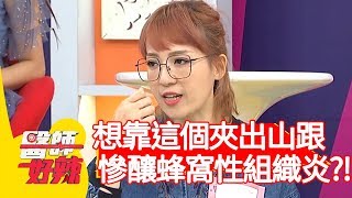 想靠「這個」夾出山跟？女病患慘釀蜂窩性組織炎？！【醫師好辣】20200226 part3 EP900 田知學 洪素卿