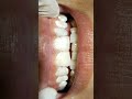 Teeth Scaling And Polishing By Haider Teethwhitening Scaling Polishing Dentist Dentistry