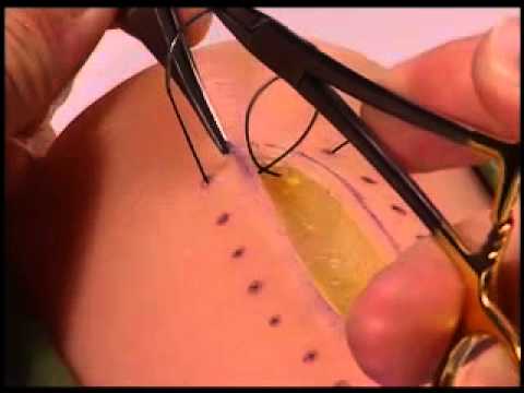 Simple Interrupted Suture with Instrument Tie