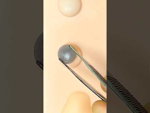 Satisfying Cyst Removal #goodtoknow #surgeonlife #vet #medicine #surgery #technique #nurse #doctor