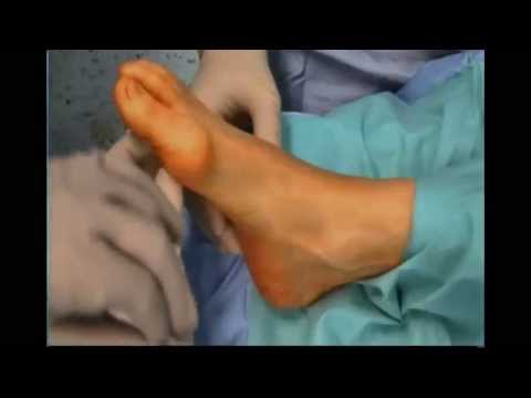 Bewertungen Blutegel von Osteochondrose Wie zervikale Osteochondrose in der Schwangerschaft zu erleichtern