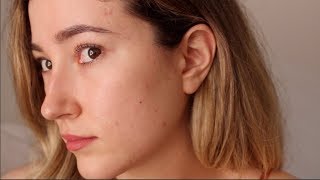 One Year Off Accutane: My Acne Is Back. An Emotional Update