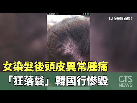 女染髮後頭皮異常腫痛　「狂落髮」韓國行慘毀