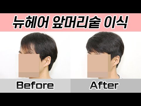 남자 앞머리갈라짐 헤어라인이식 360일 경과 I 뉴헤어 I Before&Afterㅣ모발이식