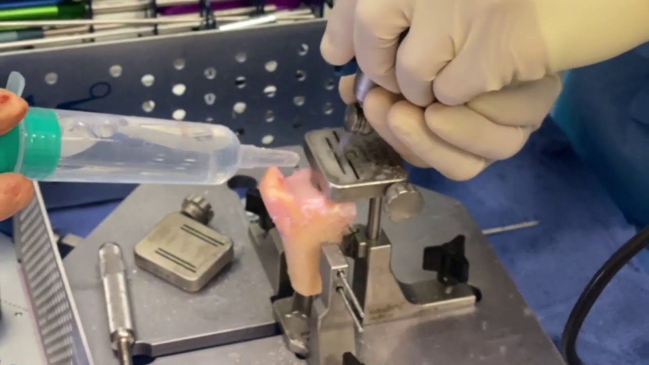 Dr. Garcia demonstrates his technically advanced technique using a Distal Tibial Allograft...