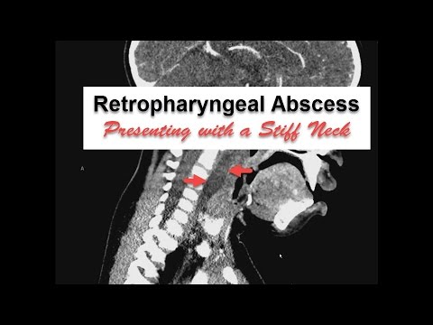 Neck Stiffness with Retropharyngeal Abscess