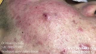 Dermatologist treating squeeze pimples,whitehead blackhead, pustule,anti acnes|N.V.T 20 Long video 1