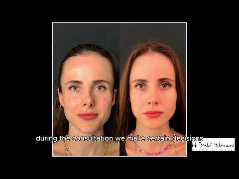 Nose Job in Turkey: Watch the Incredible Transformation | Dr. H. Baki Yılmaz