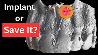 “How We Use 3D Guides for Precision Apical Surgery”