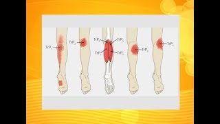What causes heavy aching legs | Usapang Pangkalusugan