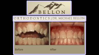 preview picture of video 'Orthodontist Littleton - Bellon Orthodontics - The Preferred Orthodontics Littleton'