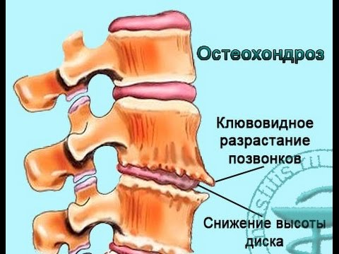 Копчиковый остеохондроз это Сустав опух на большом пальце ноги