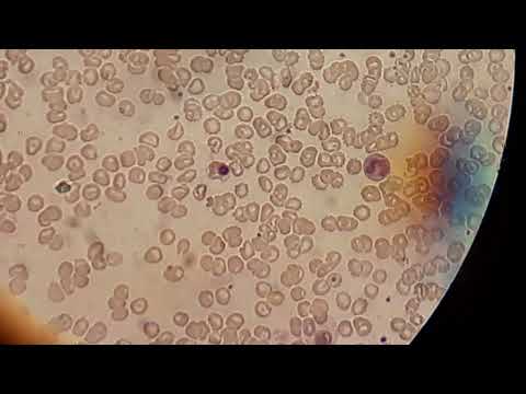 A nucleated red blood cell (NRBC) in human blood film.