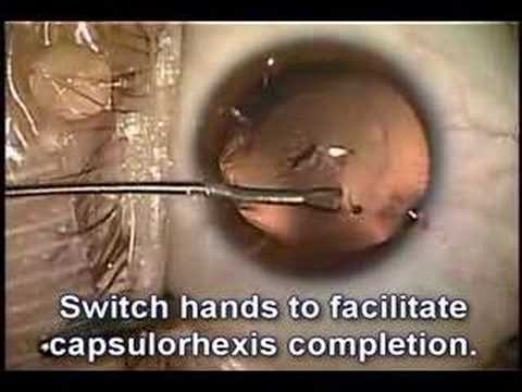 Exchange Surgery Of Refractive Lens (Crystalens)