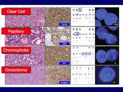 Papillary RCC: the SATURN project Vincenzo Ficarra, M.D., Ph.D.