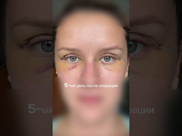 Эндоскопия верхней трети + верхняя блефаропластика
