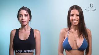 MIS IMPLANTES DE 500 CC | REALITY CAMBIOS | Cirugía Plástica Martinez