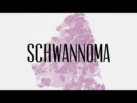 41.  Schwannoma