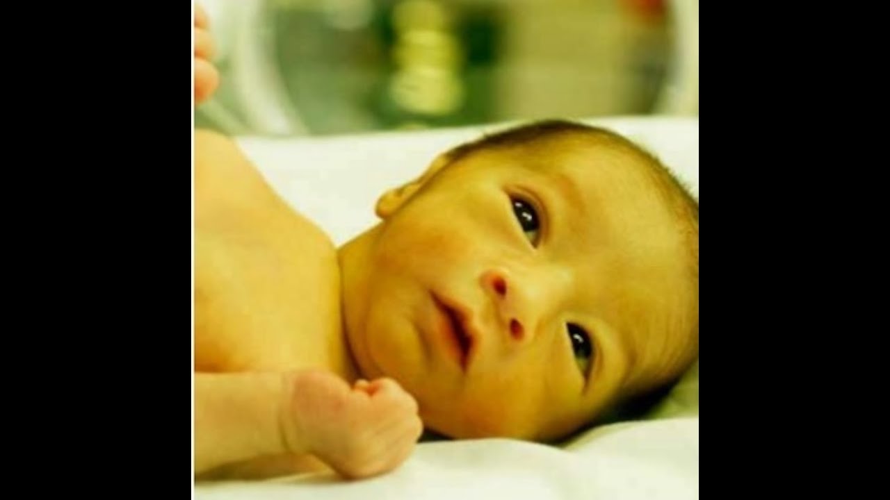 Hiperbilirrubinemia Neonatal  Nuevas guías 2022 de la AAP