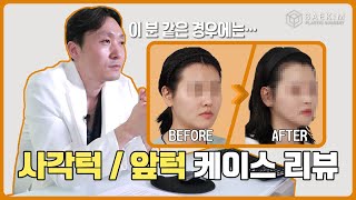윤곽수술 전후 분석, 직접 수술한 케이스로 보는 수술 포인트｜윤곽수술 케이스 리뷰(2)