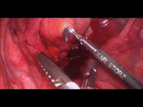 Zabieg likwidacji stomii przez wykonanie zespolenia okrężniczo-odbytniczego laparoskopowo z uzyciem staplera EEA